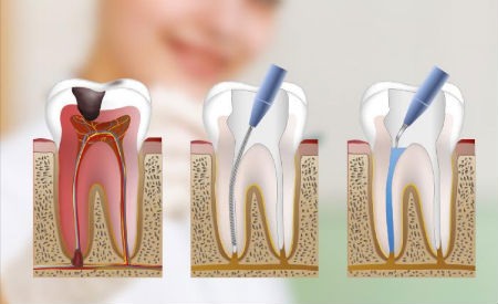 Todo lo que debes saber sobre la endodoncia